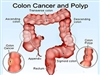   سرطان کولورکتال و پولیپ